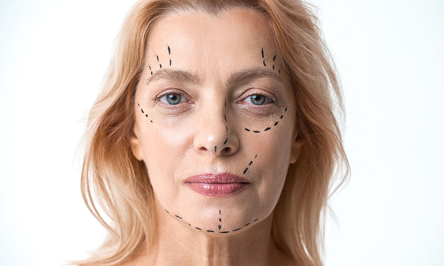 can botched facelift be fixed