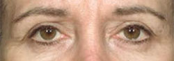 charlesthorne lower eyelid surgery2 after