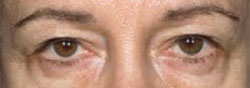 charlesthorne lower eyelid surgery2 before
