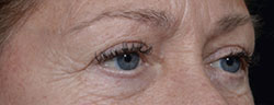 Upper Eyelid Botox Before Surgery