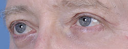 Upper Blepharoplasty After Surgery