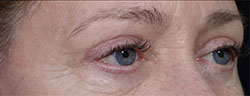Upper Eyelid Botox After Surgery