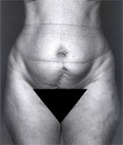 bna-lipo1b