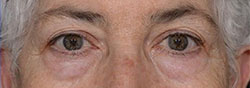 charlesthorne lower eyelid surgery3 before