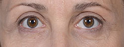 Charles Thorne Upper Eyelid Surgery2 After
