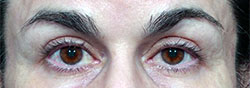 Charles Thorne Upper Eyelid Surgery3 After