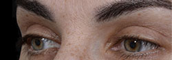 Charles Thorne Upper Eyelid Surgery4 After