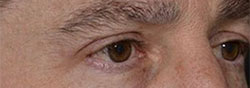 Charles Thorne Upper Eyelid Surgery5 After