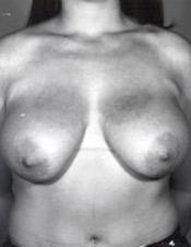 p-bef-bred-frontal-rc