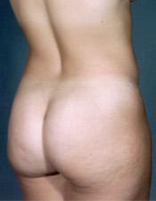 p-bef-lipo-roblique-mh