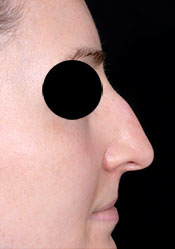 Rhinoplasty Before Surgery2