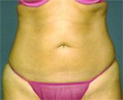 stomach lyposuction after