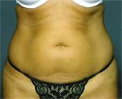 stomach lyposuction before