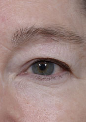 upper eyelid before