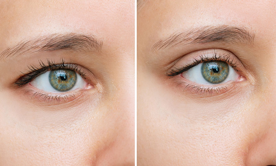 revision blepharoplasty